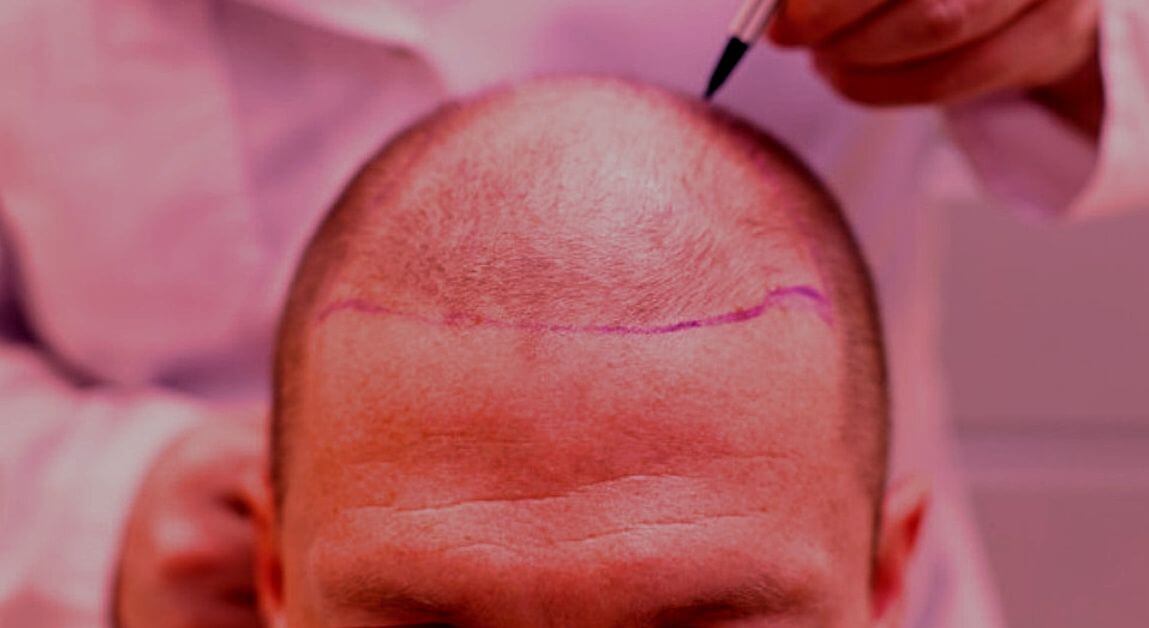 Hair Transplant Explained